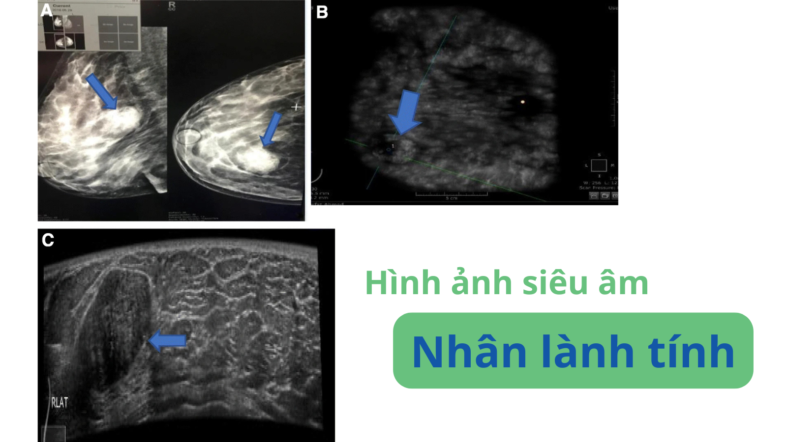 sieu-am-tuyen-vu-co-nhan-3